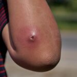 muscle abscess pain