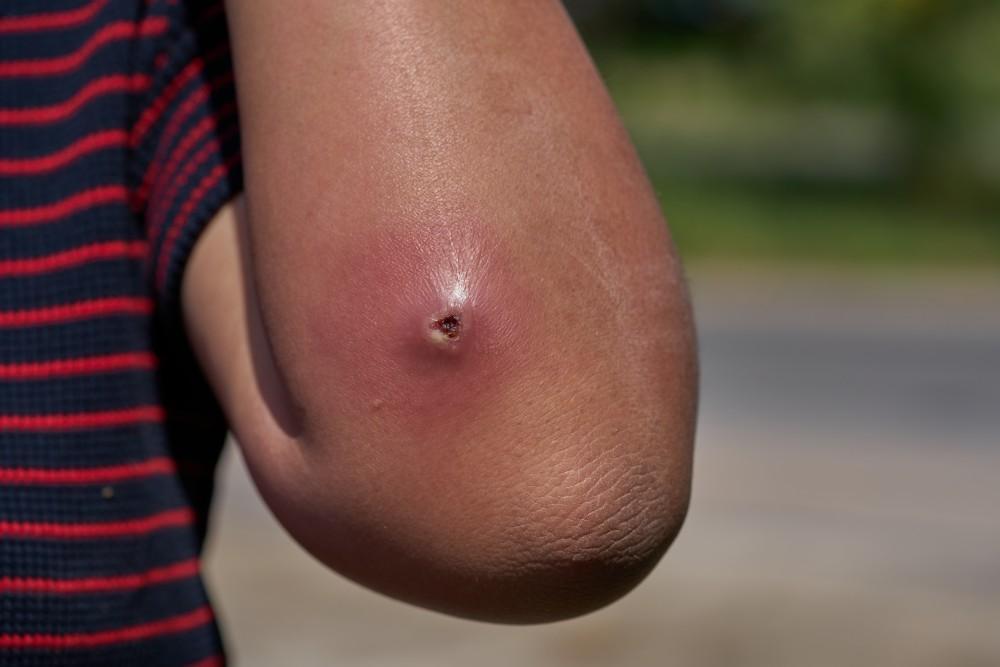muscle abscess pain