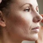 How Long Should I Wait After Subcision to Drink Caffeine