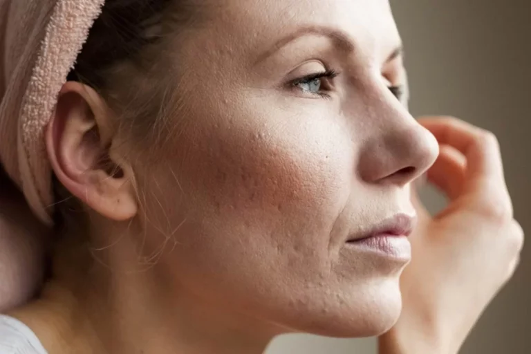 How Long Should I Wait After Subcision to Drink Caffeine